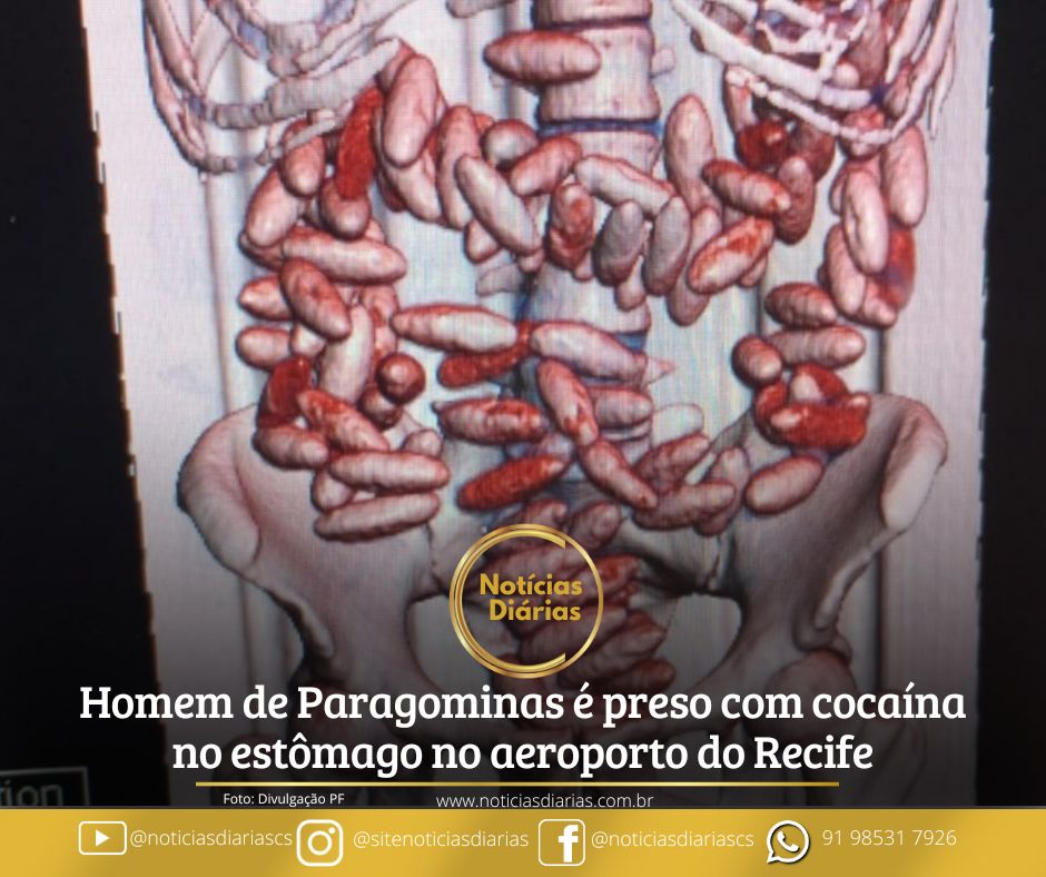 No Aeroporto Internacional do Recife, um paraense de Paragominas e uma mulher de Fortaleza foram presos em flagrante ao tentar embarcar para Lisboa com 214 cápsulas de cocaína no estômago